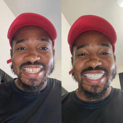 Vaneero™ Clip-on Veneers