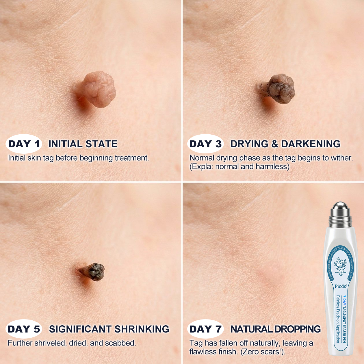 𝐏𝐢𝐜𝐝𝐨® 𝐁𝐨𝐫𝐫𝐚𝐝𝐨𝐫 𝐝𝐞 𝐞𝐭𝐢𝐪𝐮𝐞𝐭𝐚𝐬 𝐲 𝐦𝐚𝐧𝐜𝐡𝐚𝐬 𝐞𝐧 𝟕 𝐝í𝐚𝐬 (𝐀𝐩𝐥𝐢𝐜𝐚𝐝𝐨𝐫 𝐫𝐨𝐥𝐥-𝐨𝐧: 𝐬𝐢𝐧 𝐝𝐨𝐥𝐨𝐫 𝐧𝐢 𝐜𝐢𝐜𝐚𝐭𝐫𝐢𝐜𝐞𝐬)